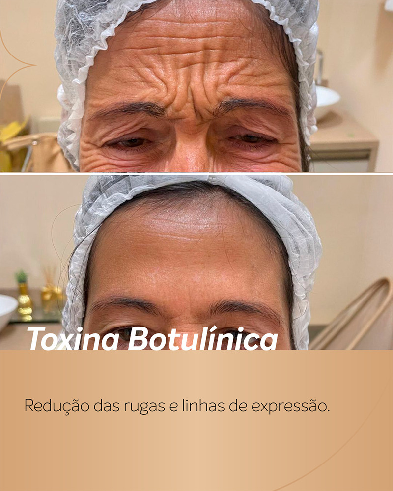 antes e depois botox testa