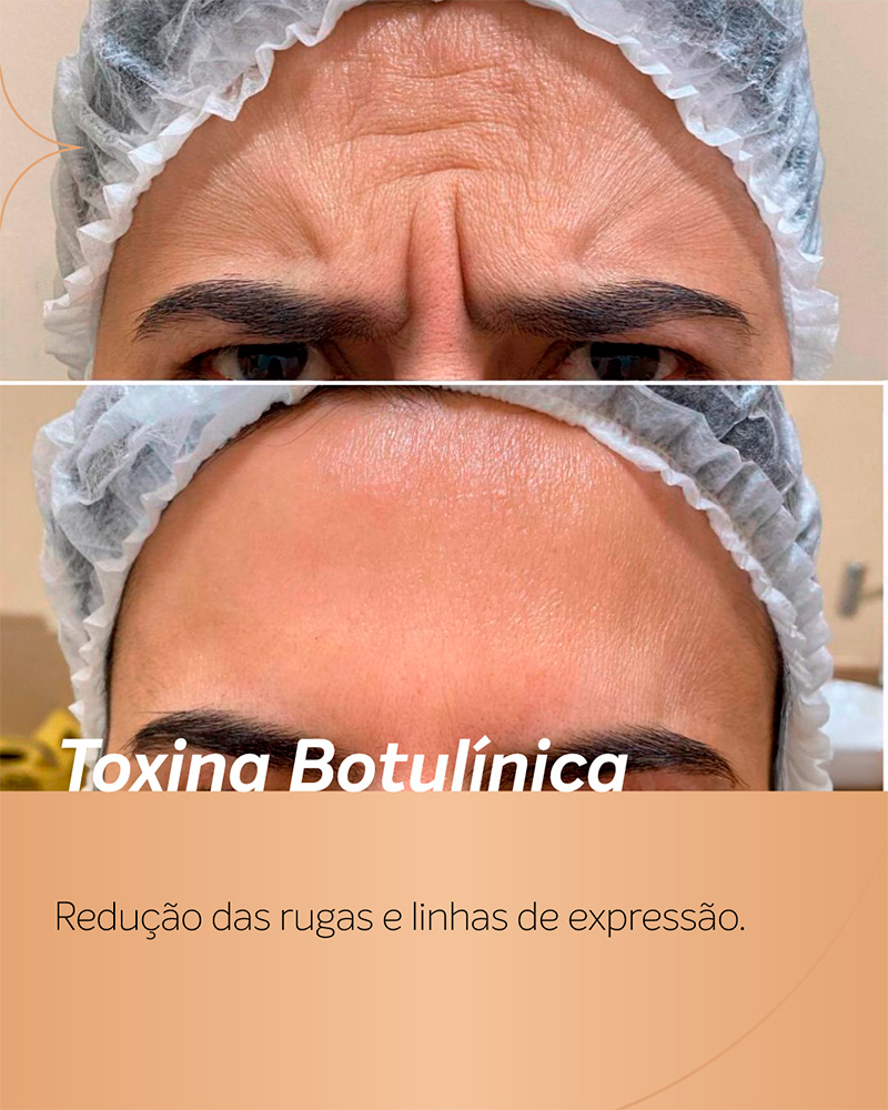 Antes e depois de toxina botulínica na testa, mostrando suavização das linhas horizontais e do sulco entre as sobrancelhas.