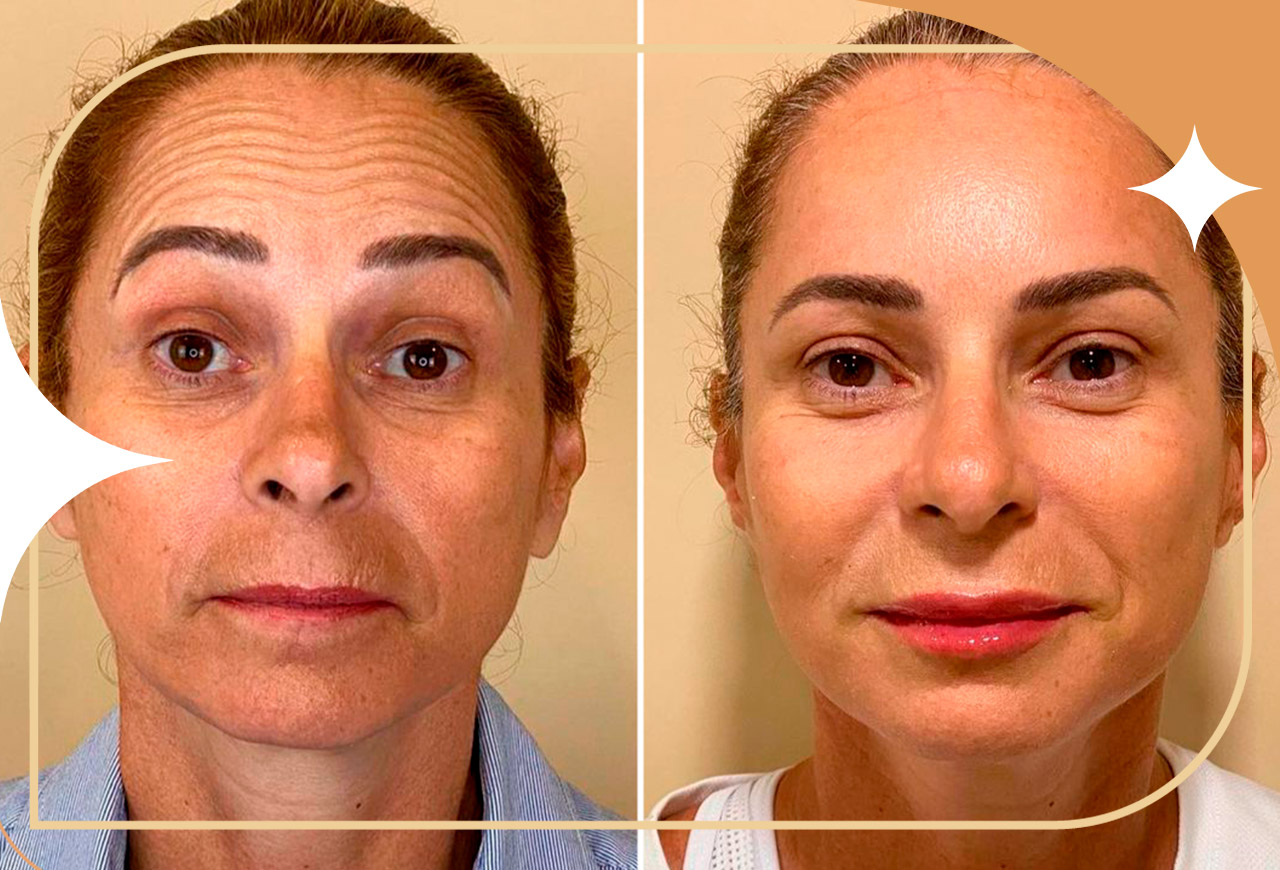 imagem de botox antes e depois na testa e abaixo dos olhos de uma mulher revelando uma pele mais lisa nas regiões