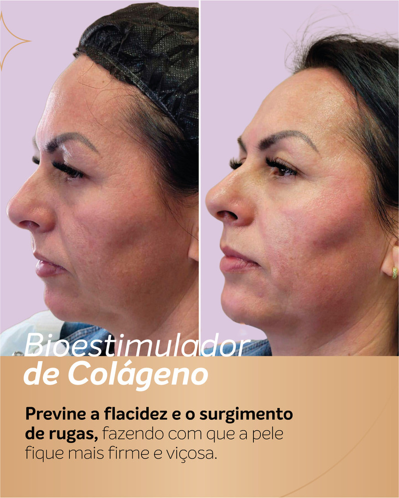 Antes e depois de bioestimulador de colágeno em paciente vista de perfil