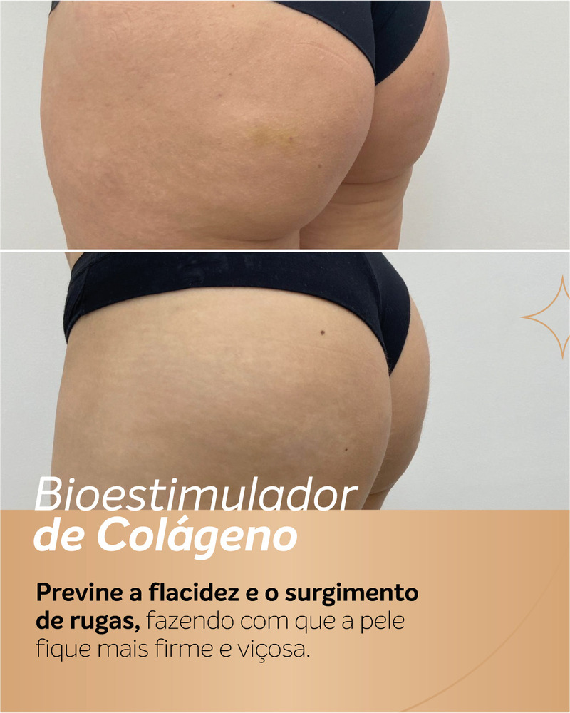 Antes e depois de bioestimulador de colágeno nos glúteos em vista lateral