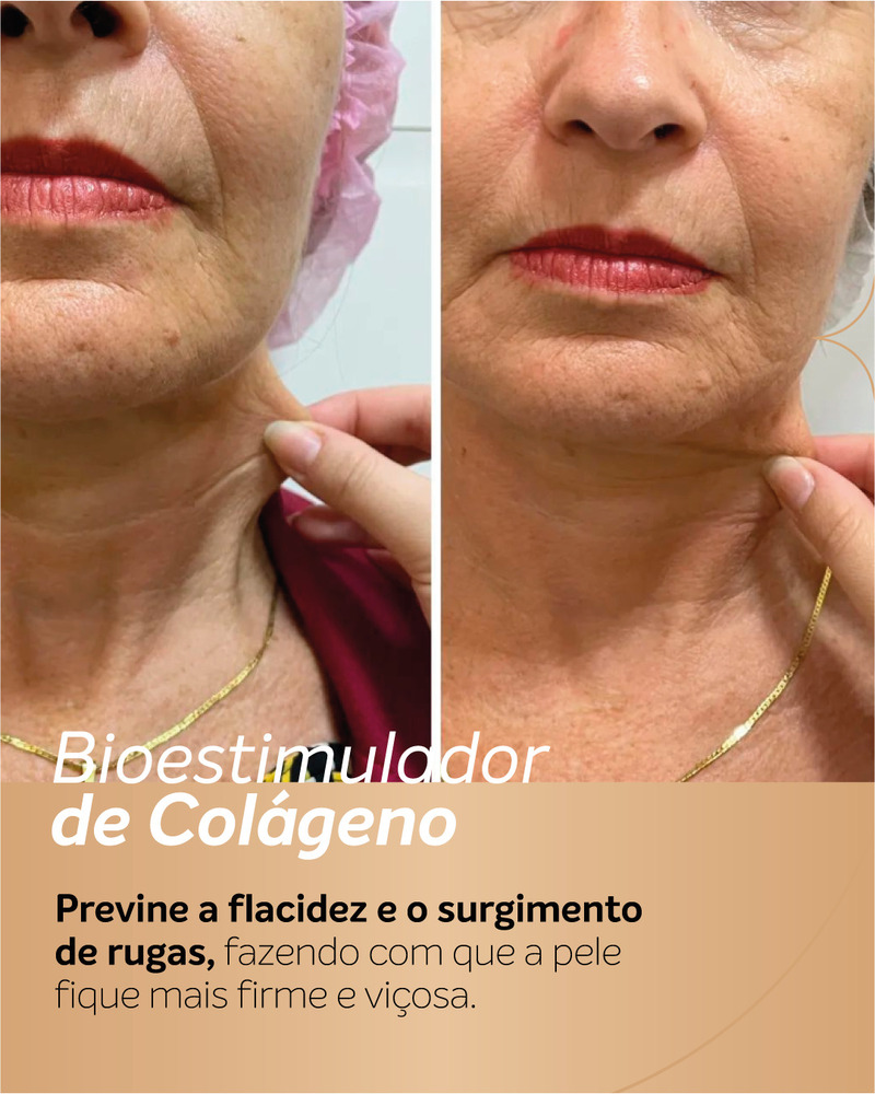 Antes e depois de bioestimulador de colágeno no pescoço e parte inferior do rosto