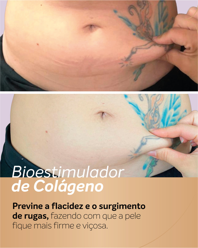 Antes e depois de bioestimulador de colágeno no abdômen, com teste manual de firmeza da pele