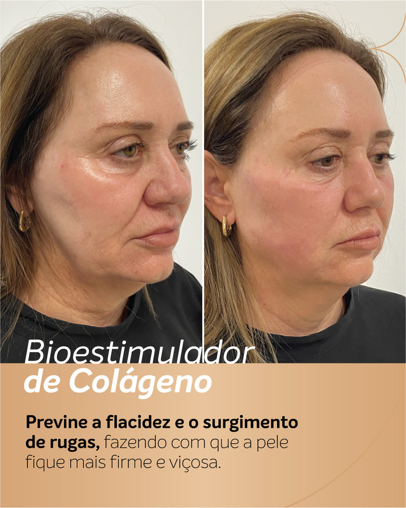 Antes e depois do bioestimulador de colágeno em paciente vista de perfil.