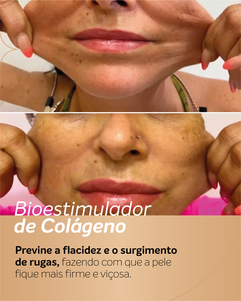 Antes e depois de bioestimulador de colágeno na região inferior do rosto.