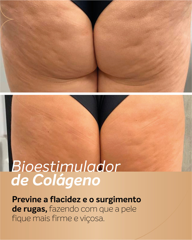 Antes e depois de bioestimulador de colágeno nos glúteos, com foco na textura da pele