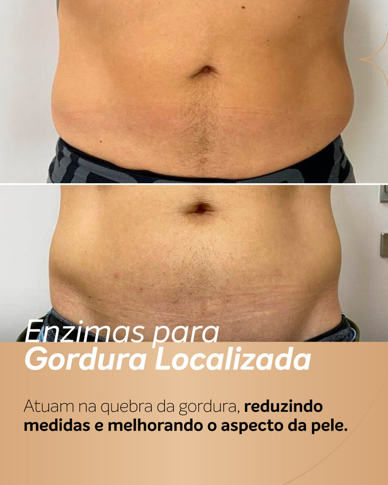 Aplicação de enzimas no abdômen masculino antes e depois, com redução da gordura localizada e aspecto mais plano da barriga