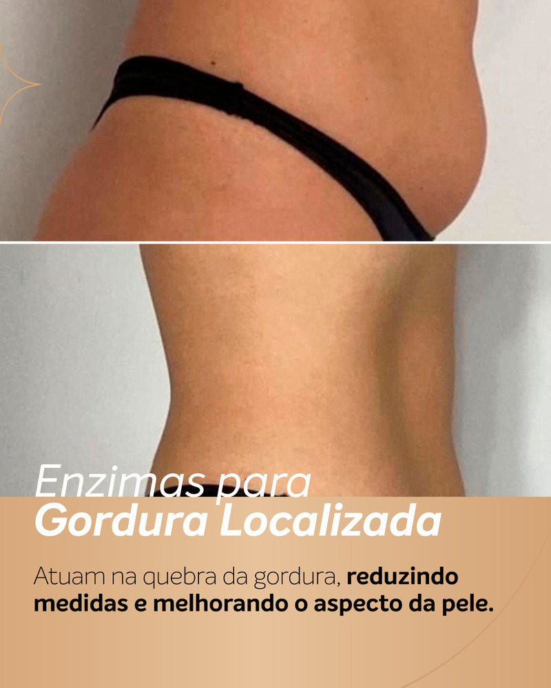 Enzimas para gordura localizada antes e depois no baixo-ventre, com melhora do contorno abdominal lateral.