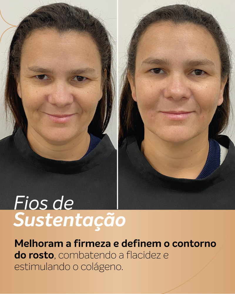 Nesta paciente, é visível a melhora da pele abaixo do queixo e no pescoço com um aspecto mais uniforme nessa região, redução do excesso de pele aparente e linhas menos marcadas.