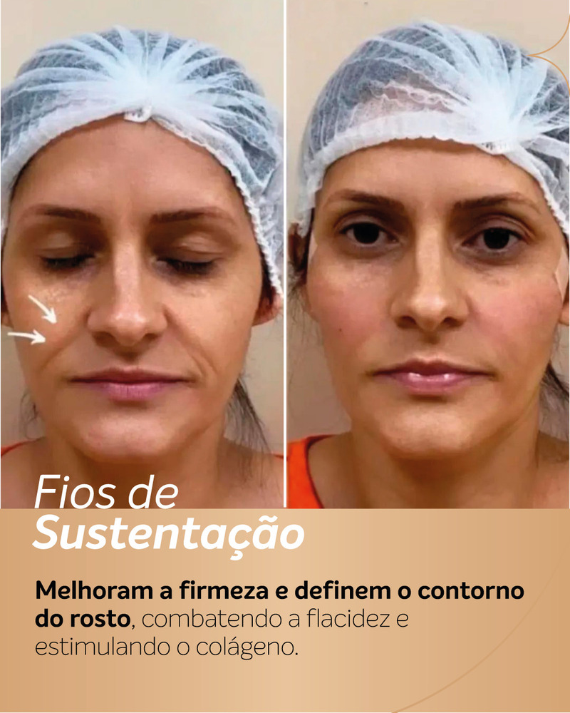 ntes e depois de fios de PDO na região das bochechas e do bigode chinês