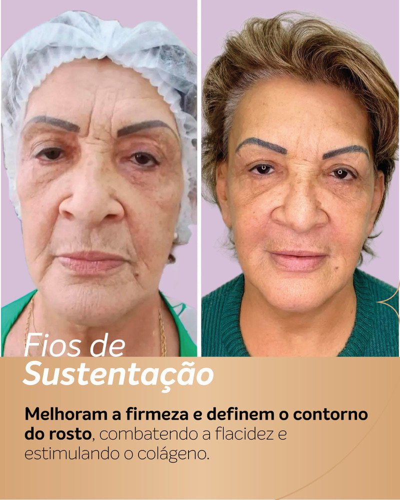 Antes e depois de tratamento com fios de PDO em paciente madura, mostrando melhora da firmeza da pele, suavização da flacidez e maior definição do contorno facial, especialmente na região da mandíbula e do terço inferior do rosto