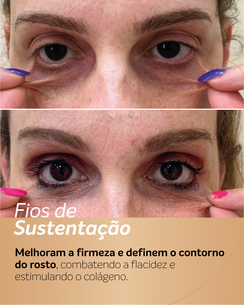 Antes e depois de fios de PDO na região dos olhos, mostrando melhora da firmeza da pele abaixo dos olhos e redução da frouxidão cutânea em área delicada do rosto.