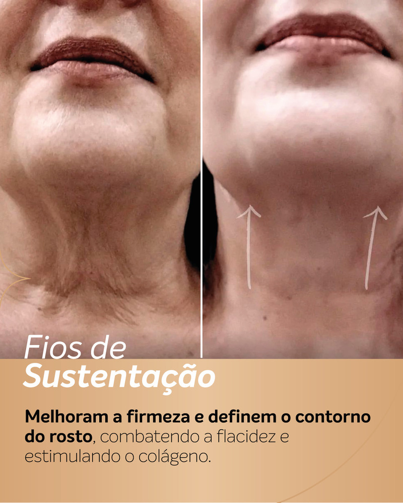 Antes e depois de fios de PDO na região do queixo e pescoço, mostrando melhora do suporte da pele, aspecto mais firme e contorno mais elevado abaixo do rosto.