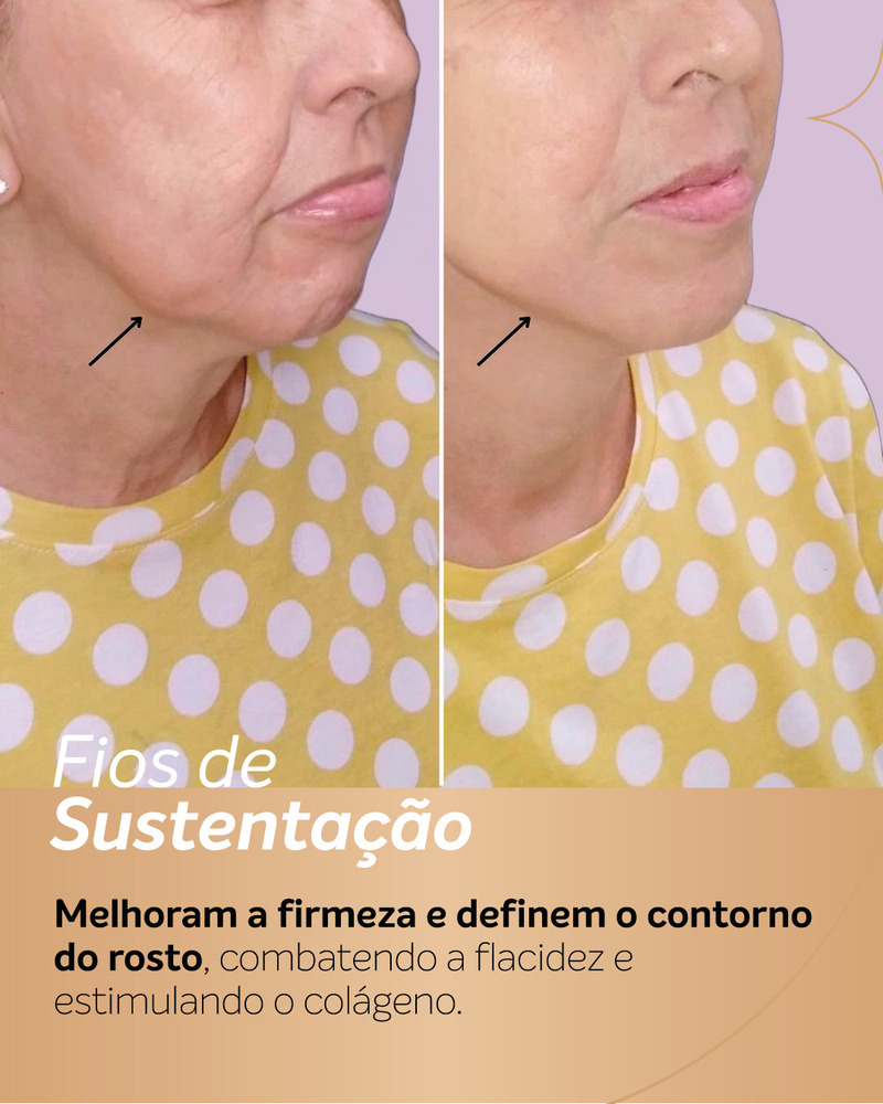 Antes e depois de fios de PDO na região da mandíbula e do pescoço.