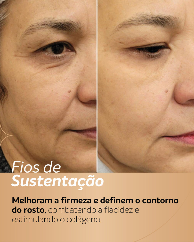 Antes e depois de fios de PDO em vista de 3/4 do rosto.