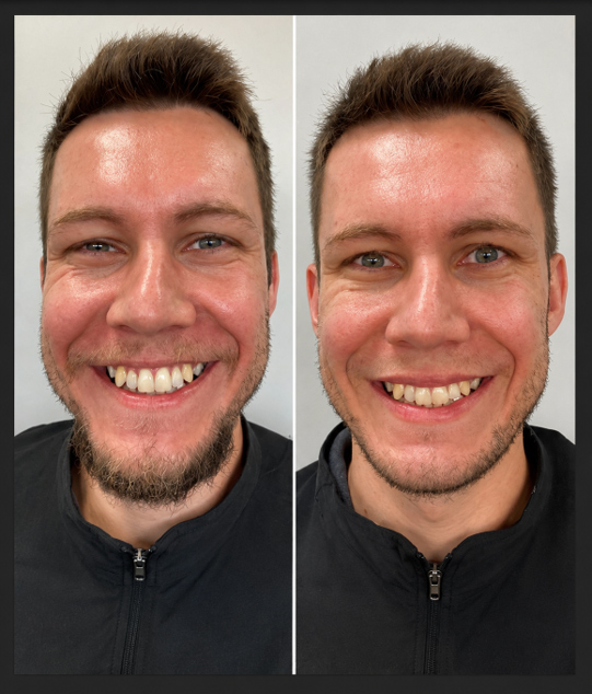 Antes e depois de PDRN em homem. A comparação mostra uma pele com textura mais regular e aparência mais saudável após o tratamento.