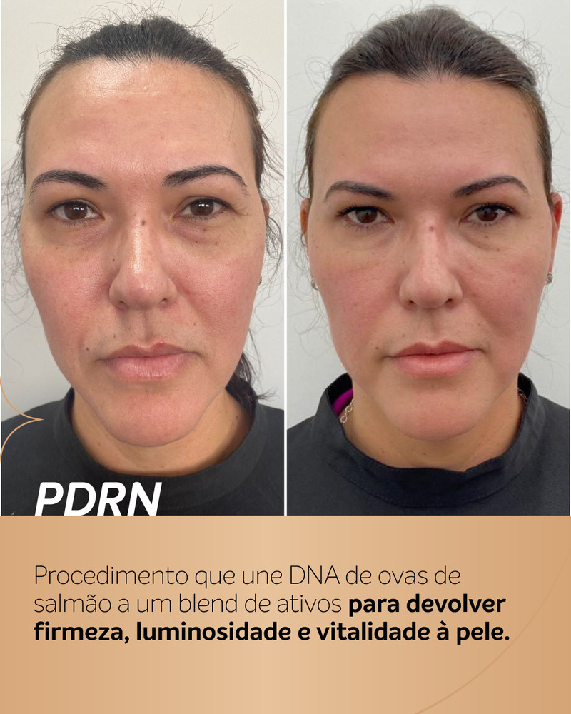 Antes e depois de PDRN em paciente feminina, com foco na textura e na uniformidade da pele