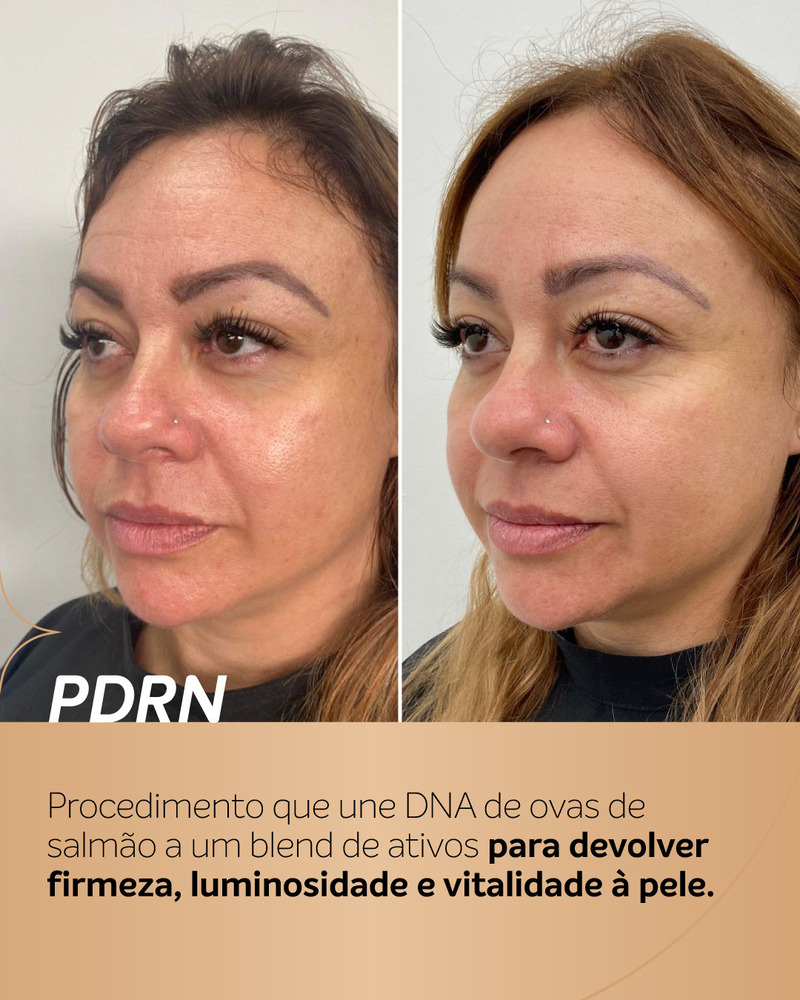 Antes e depois de PDRN em uma mulher. A comparação mostra a pele com aspecto mais luminoso, textura mais uniforme e tom mais homogêneo, especialmente na região das bochechas e da testa.