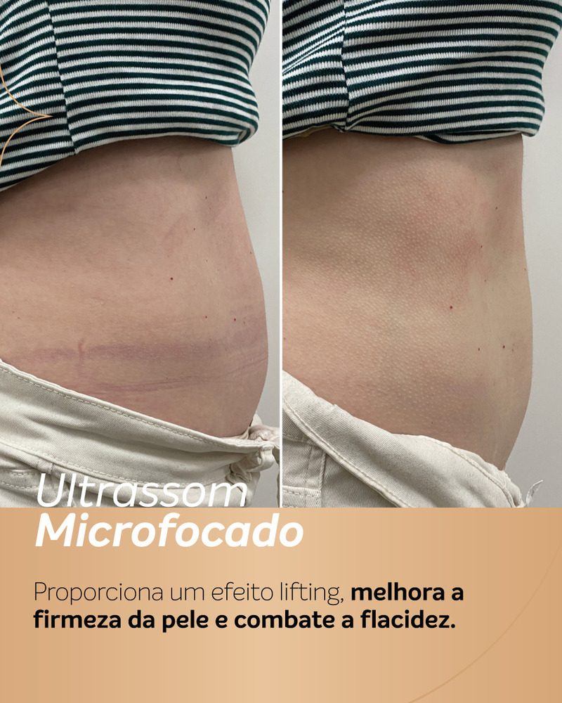 Imagem de antes e depois de ultrassom microfocado na barriga em vista lateral, mostrando pele mais firme e uniforme após o tratamento.