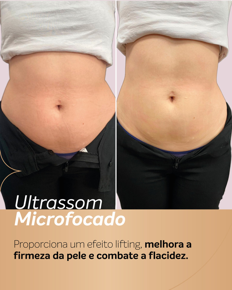 Foto de antes e depois de ultrassom microfocado na barriga, mostrando melhora da firmeza da pele e redução da flacidez na parte inferior do abdômen.