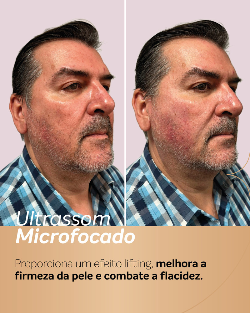 Foto de antes e depois de ultrassom microfocado em homem, mostrando melhora da firmeza da pele, maior definição da linha da mandíbula e do contorno do maxilar.