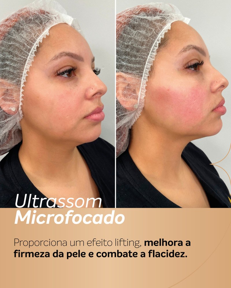 Foto de antes e depois de ultrassom microfocado no rosto em paciente jovem, mostrando melhora da firmeza da pele, maior definição do contorno facial e da região da mandíbula.