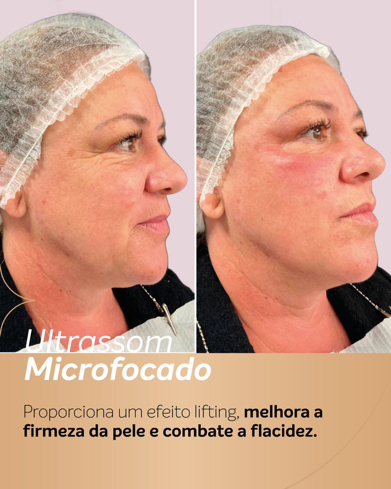 Antes e depois de ultrassom microfocado em paciente com pele madura, mostrando melhora da firmeza no contorno do rosto e maior definição da linha da mandíbula.
