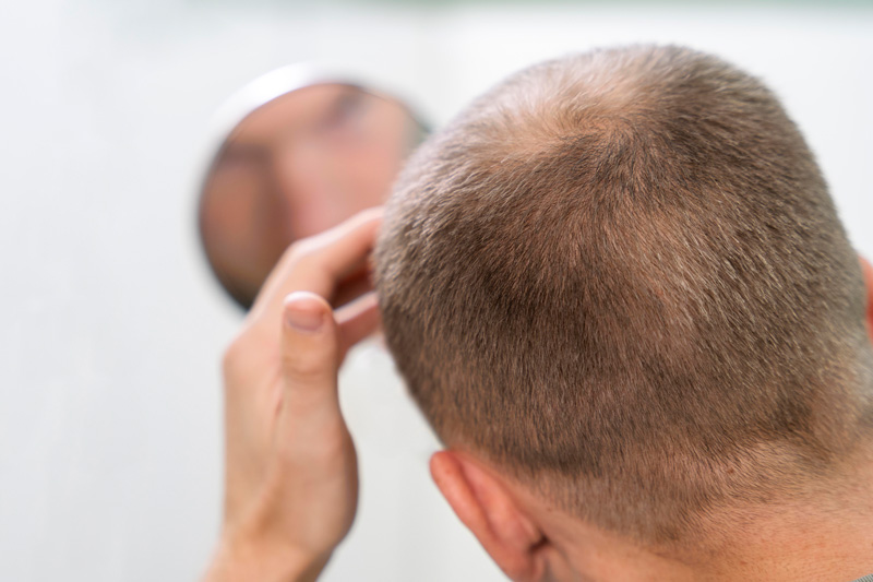 Homem de cabelo curto com a mão na cabeça observando padrão de queda capilar no espelho.