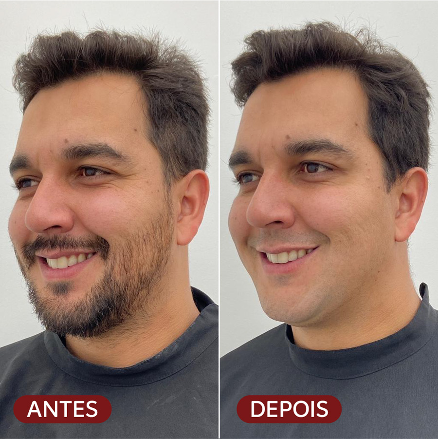 Fotos de antes e depois de procedimento Botox Dysport: melhora da firmeza e sustentação da pele.