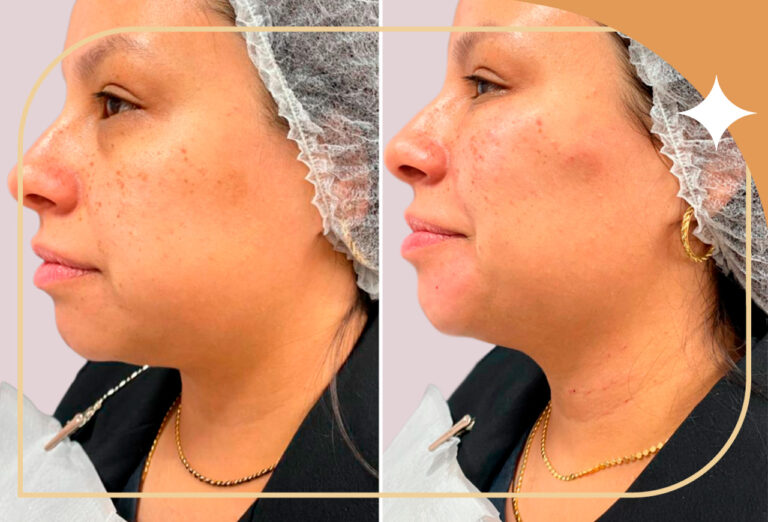 Antes e depois: Skinbooster