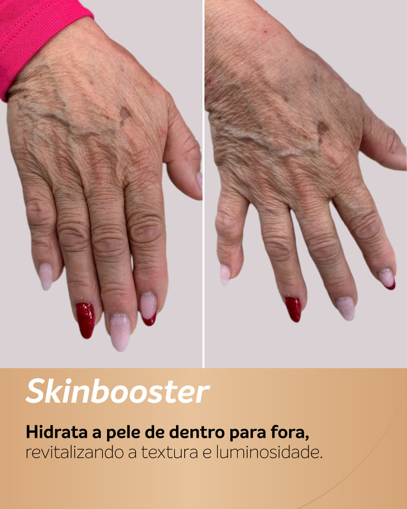 Antes e depois de Skinbooster no dorso das mãos, mostrando melhora na hidratação, textura e suavização das linhas da pele.