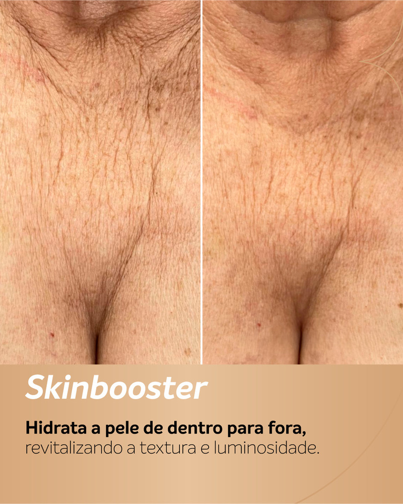 Antes e depois de Skinbooster no colo (região do decote), mostrando melhora na hidratação, textura e suavização das linhas da pele.