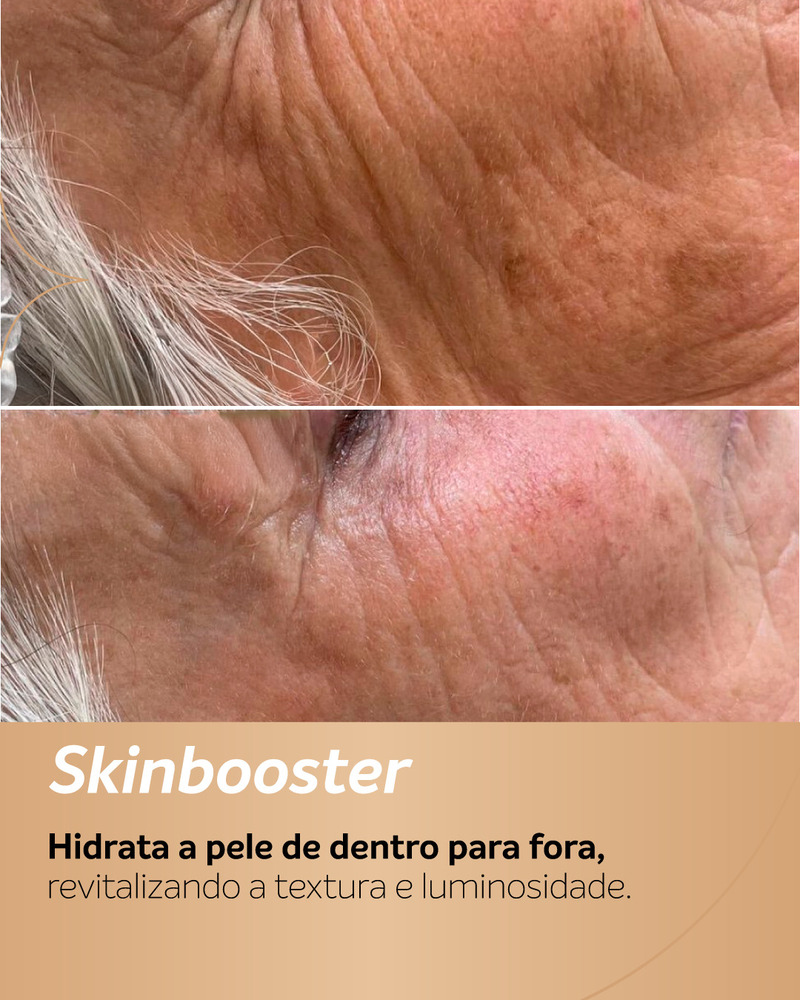 Antes e depois de Skinbooster no rosto em pele madura, mostrando melhora na hidratação, textura e suavização das linhas.