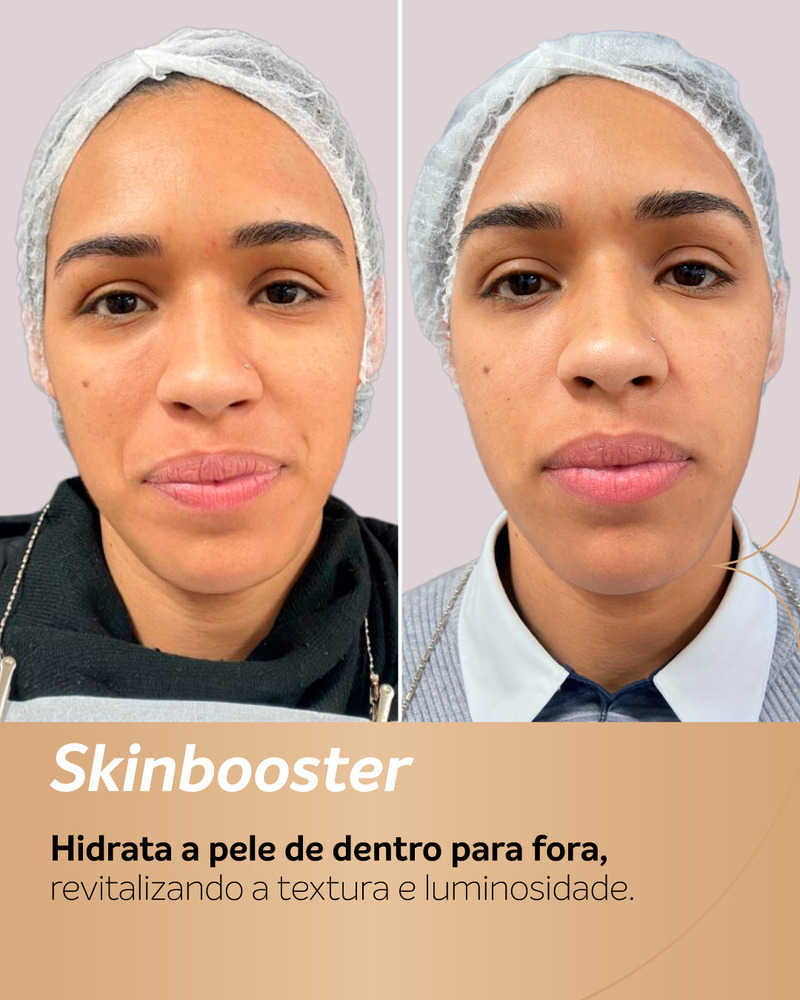 Na pele madura, o Skinbooster melhora a hidratação, o viço e a textura, promovendo a suavização de linhas finas e devolvendo a jovialidade de forma natural. Essa diferença é fundamental para avaliar o antes e depois com uma expectativa realista. No antes e depois do Skinbooster no rosto da paciente, é visível a transição de uma pele opaca e com linhas marcadas para uma aparência profundamente hidratada, radiante e descansada, valorizando assim a beleza natural da pele sem perder a sua essência. Para rugas mais acentuadas, o procedimento atua como uma excelente base de tratamento e pode ser combinado a procedimentos como preenchimento ou toxina botulínica. Cada protocolo é personalizado após uma avaliação detalhada, garantindo que a escolha das técnicas respeite os objetivos e a anatomia de cada paciente. Leia também: Botox: antes e depois com resultados reais Skinbooster em pele jovem: prevenção e viço